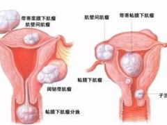 当试管婴儿遇上子宫肌瘤
