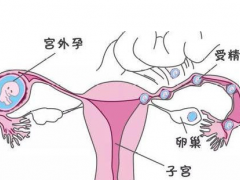 多次宫外孕泰国试管婴儿成功率高吗？