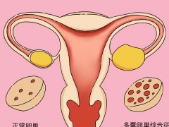 多囊卵巢患者有几种怀孕方法?只能做试管了